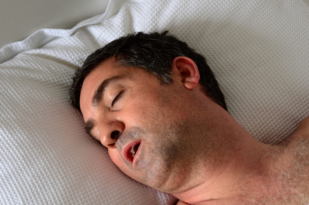 Sleep Apnea Surgery Procedure Description