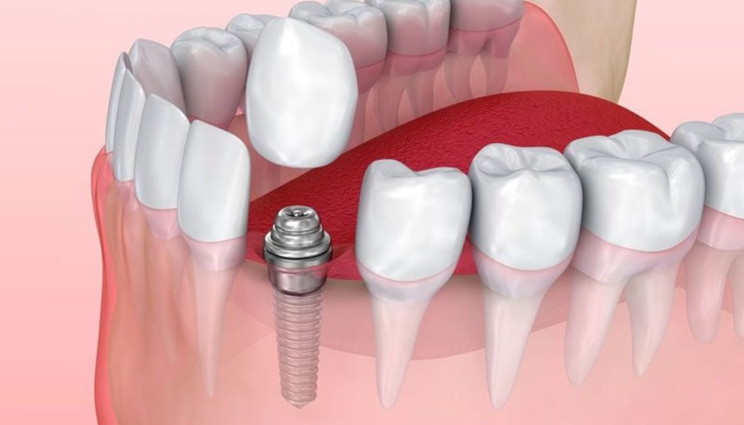 Top Tips on Having Dental Implants in Thailand