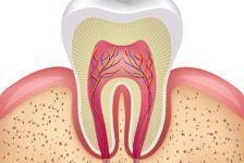 Top Tips on Having a Root Canal in Thailand