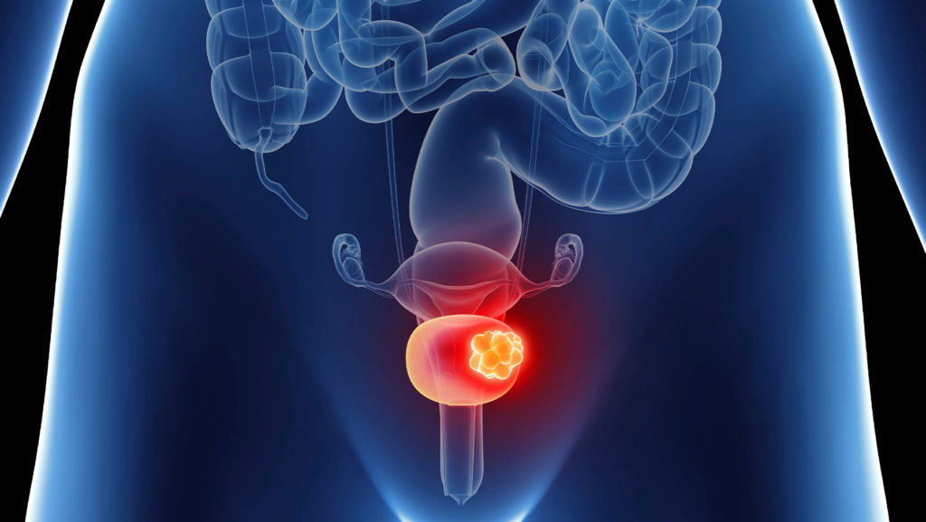 Bladder Cancer Treatment Procedure Description