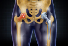 Hip Surgery Procedure Description