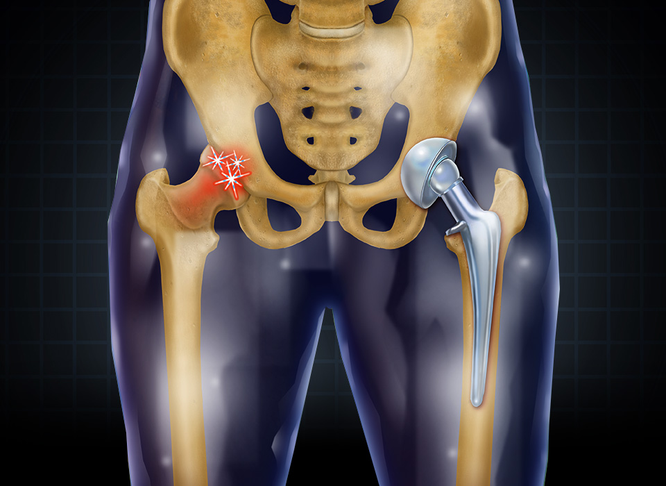 Hip Surgery Procedure Description