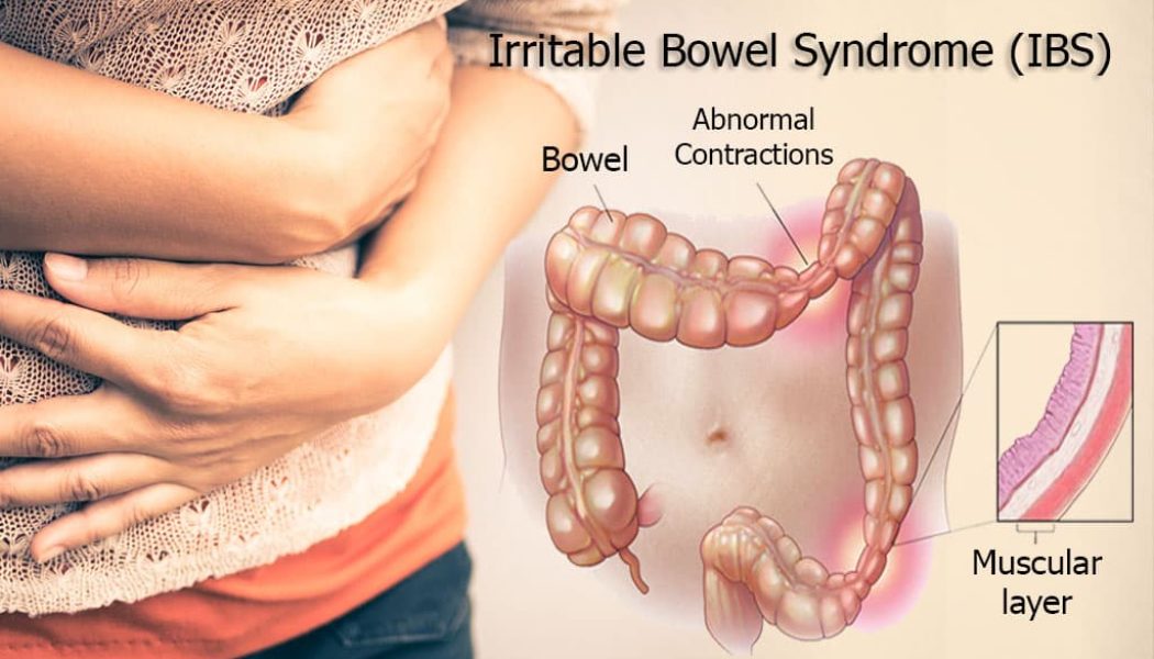 Irritable Bowel Syndrome (IBS) Treatment Procedure Description