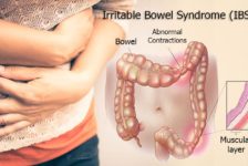 Irritable Bowel Syndrome (IBS) Treatment Procedure Description