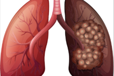 Lung Cancer Treatment Procedure Description