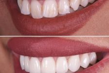 Top Facts Regarding Veneers in Thailand