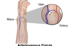 Atrioventricular Fistula Treatment Procedure Description