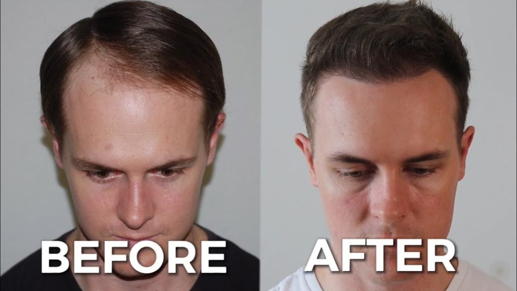 Hair Transplant FAQ