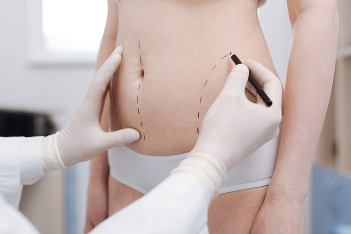Liposuction FAQ