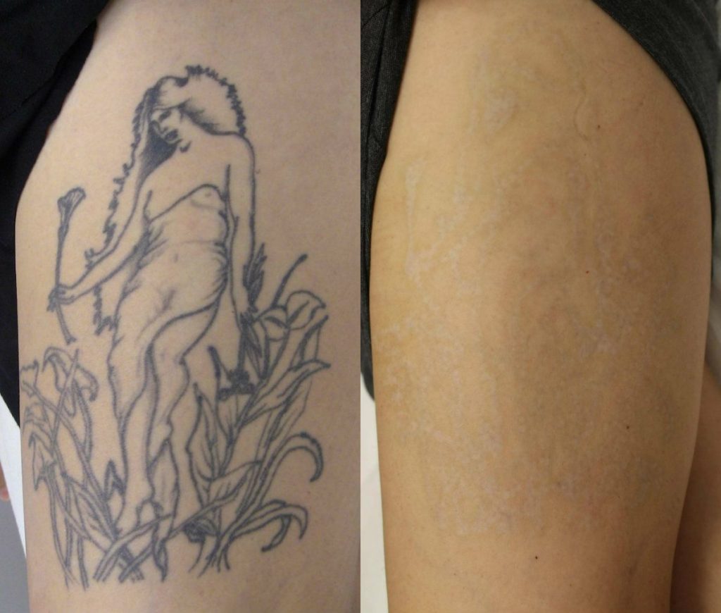 Laser Tattoo Removal FAQ