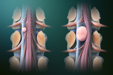 Spinal Tumor Removal Procedure Description