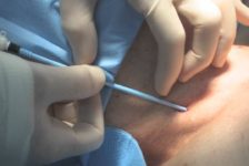 Pulmonary Artery Catheter Insertion Procedure Description