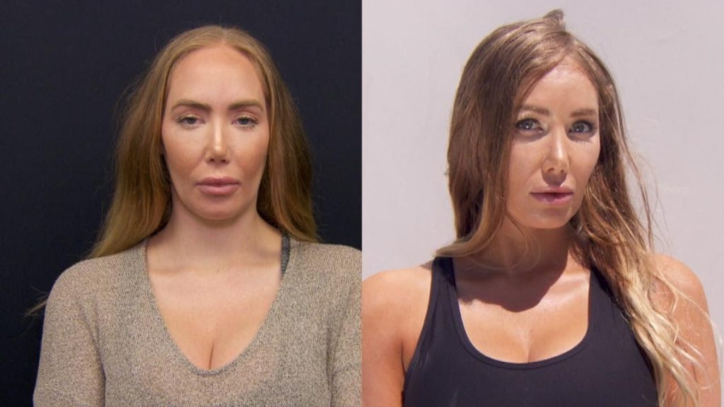 Hairline Lowering Surgery FAQ