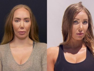 Hairline Lowering Surgery FAQ