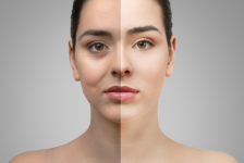 The Benefits of Eyelid Surgery