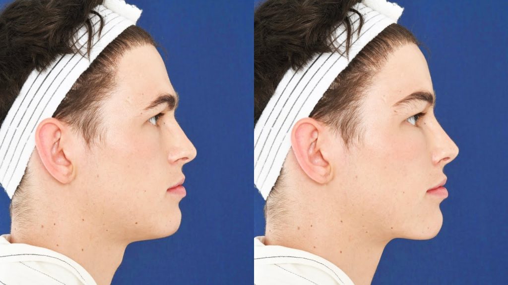 Top 6 Benefits of Facial Feminization Surgery (FFS)