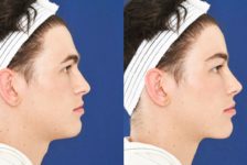 Top 6 Benefits of Facial Feminization Surgery (FFS)