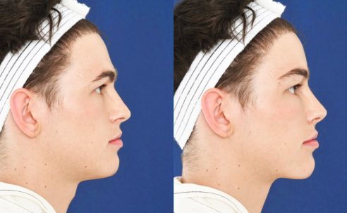 Top 6 Benefits of Facial Feminization Surgery (FFS)