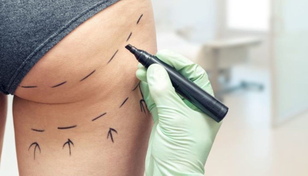 6 Benefits of Having a Brazilian Butt Lift