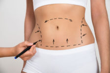 6 Benefits of CoolSculpting Treatments