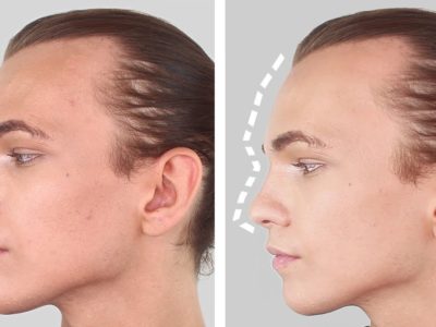 Facial Feminization Surgery (FFS) FAQ