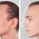 Facial Feminization Surgery (FFS) FAQ