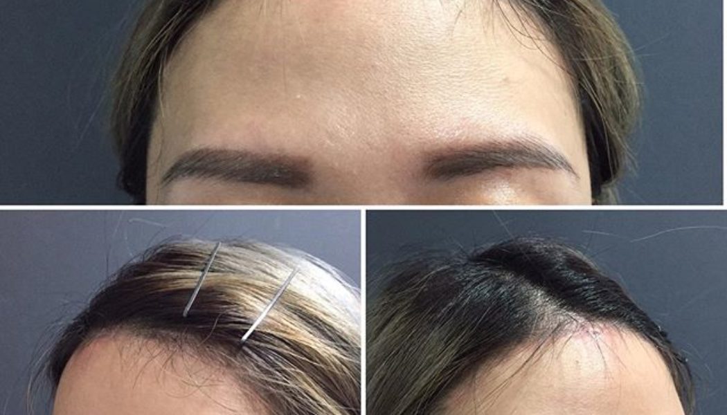 Benefits and Expectations of Hairline Lowering Surgery