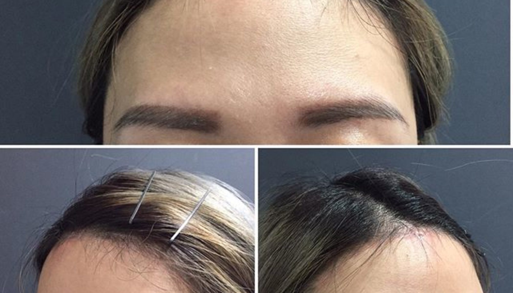 Benefits And Expectations Of Hairline Lowering Surgery - MyMediTravel ...