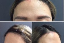 Benefits and Expectations of Hairline Lowering Surgery