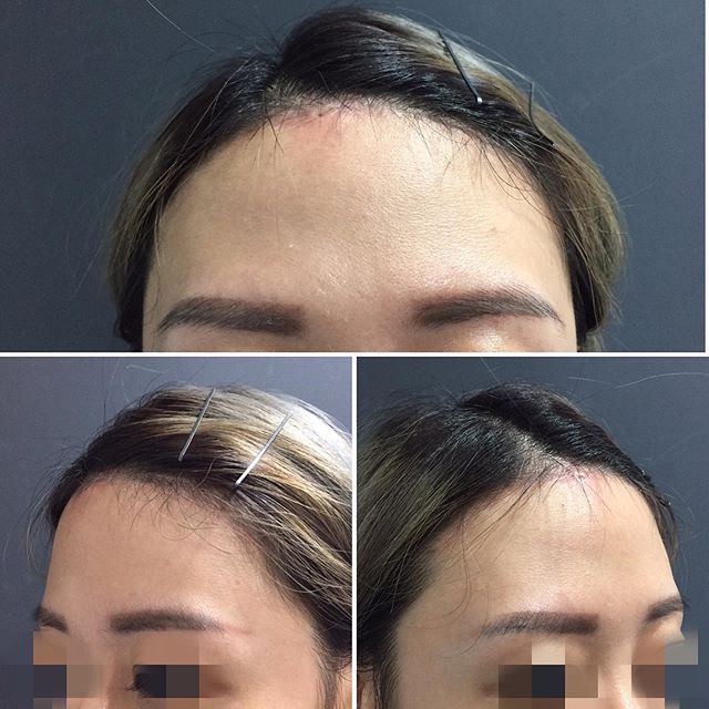 Benefits and Expectations of Hairline Lowering Surgery