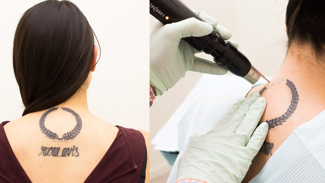 Laser Tattoo Removal Machines | Pulse Light Clinic London