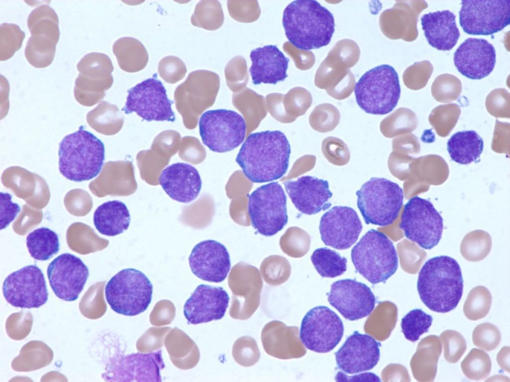 Acute Leukemia Treatment Procedure Description