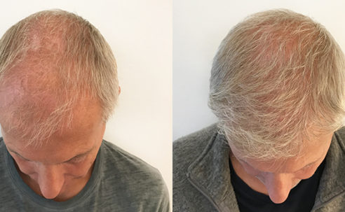 The Benefits of a Hair Transplant