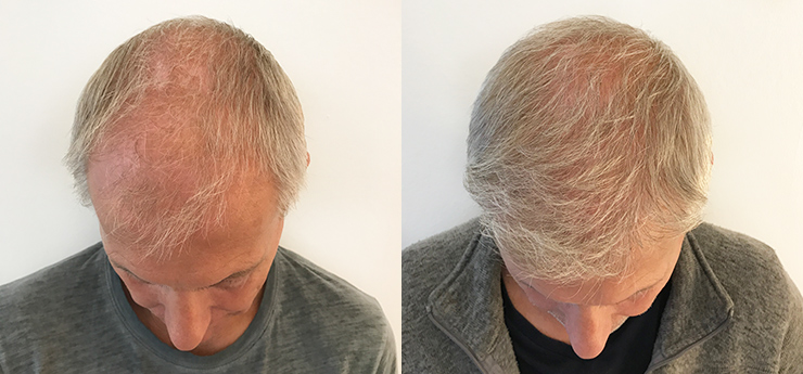 The Benefits of a Hair Transplant