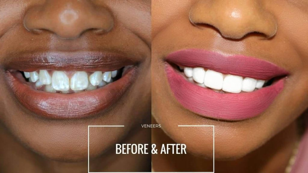 Veneers FAQ MyMediTravel Knowledge