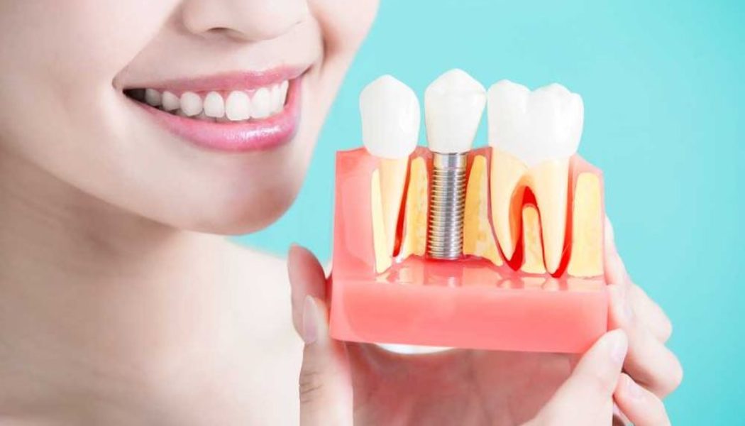 Dental Implant FAQ