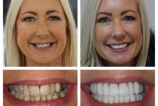 The Benefits of Veneers that will Improve my Smile