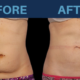 Top Answers to Having CoolSculpting Treatments in Thailand