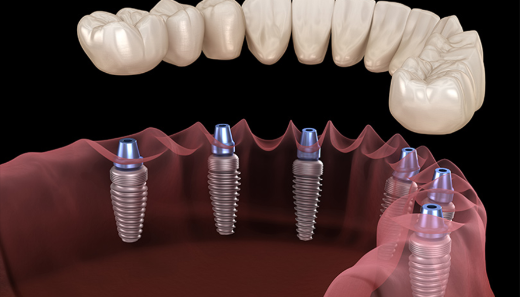 Top Tips to Improve Your Smile With an All-on-6 Dental Implants in Bangkok