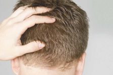 Top 4 Locations for a Hair Transplant in Thailand