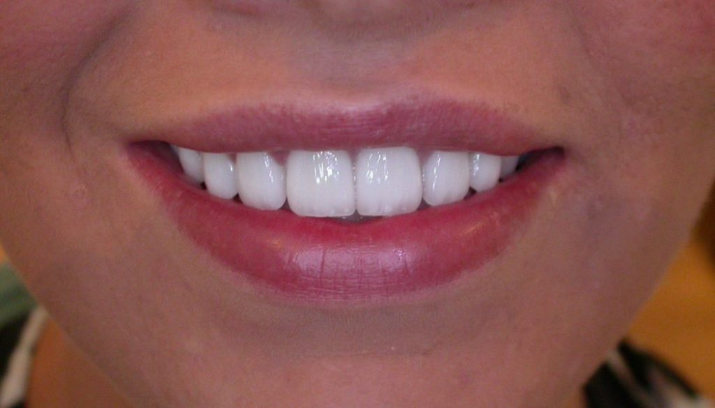 Top 3 Reasons to Getting a Perfect Smile with Veneers in Turkey