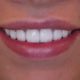 Top 3 Reasons to Getting a Perfect Smile with Veneers in Turkey