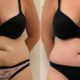 Top 8 reasons to have Tummy Tuck Surgery in Thailand