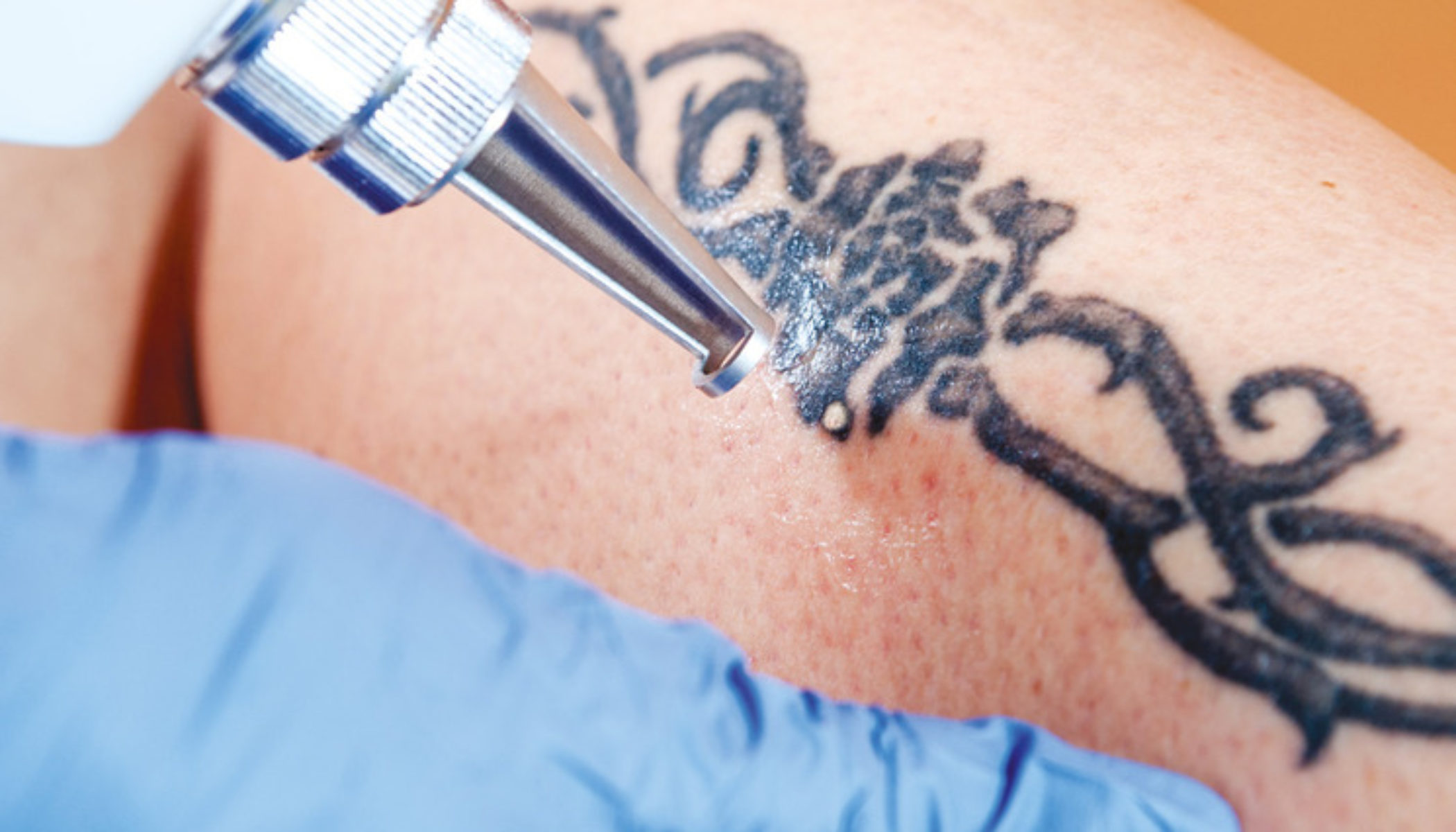 The Benefits and Risks of Laser Tattoo Removal | MyMediTravel ...