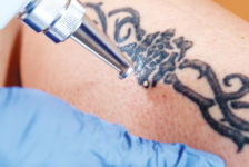 The Benefits and Risks of Laser Tattoo Removal