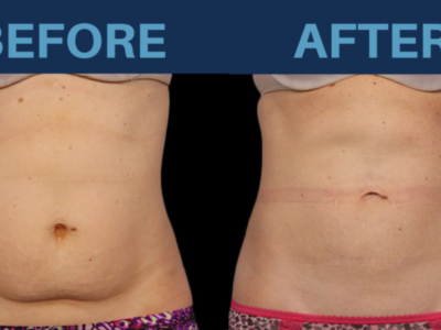 Top Facts on Having CoolSculpting in Turkey