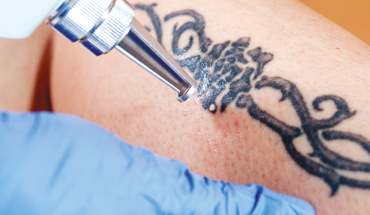 The Benefits and Risks of Laser Tattoo Removal