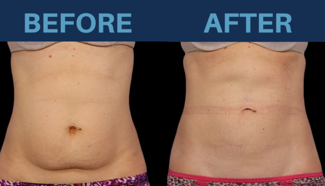 Top Facts on Having CoolSculpting in Turkey