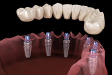 Top Tips to Improve Your Smile With an All-on-6 Dental Implants in Bangkok