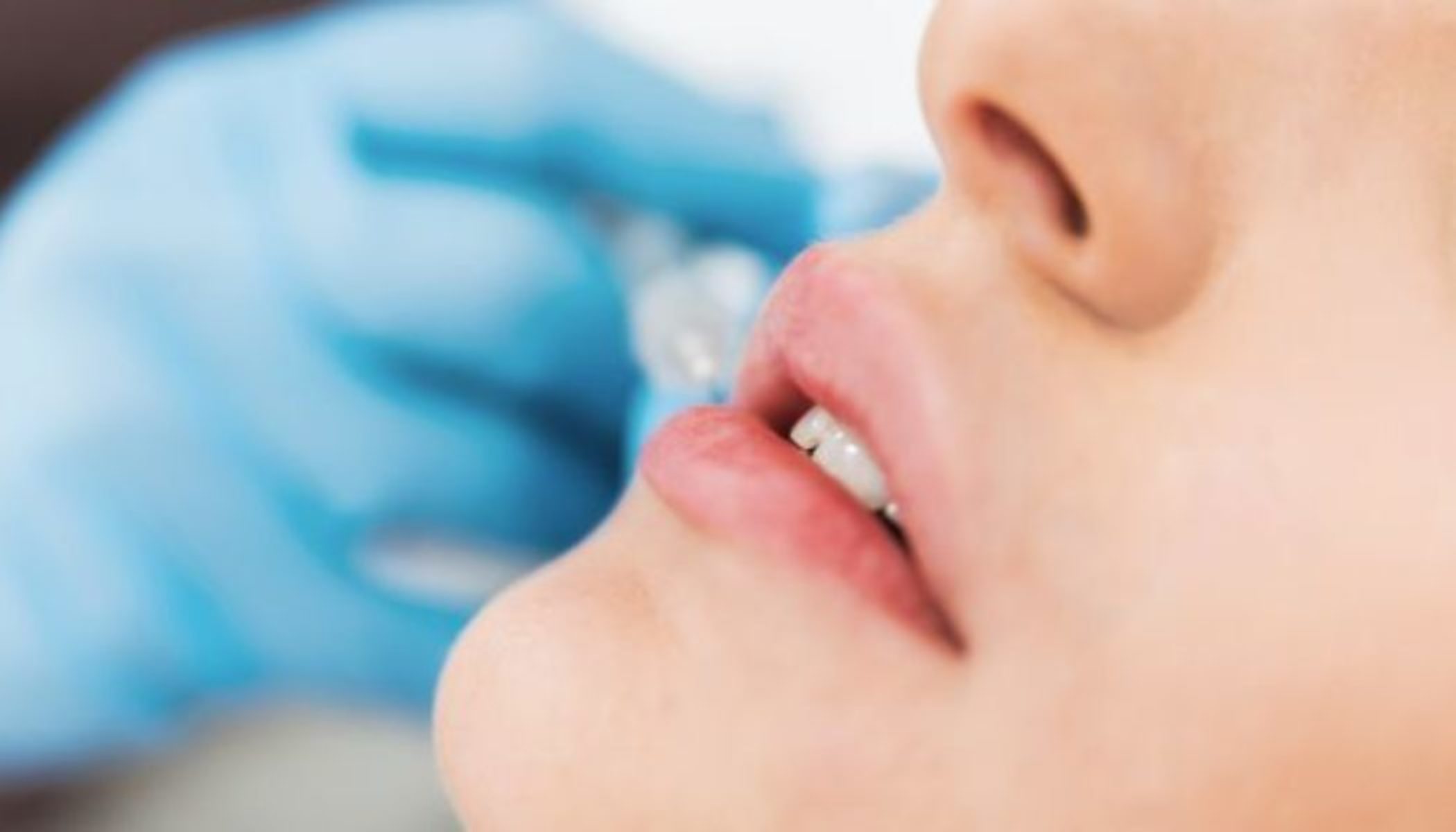 Top Tips on Having Lip Fillers in Turkey MyMediTravel Knowledge